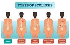 Scoliosis Symptoms
